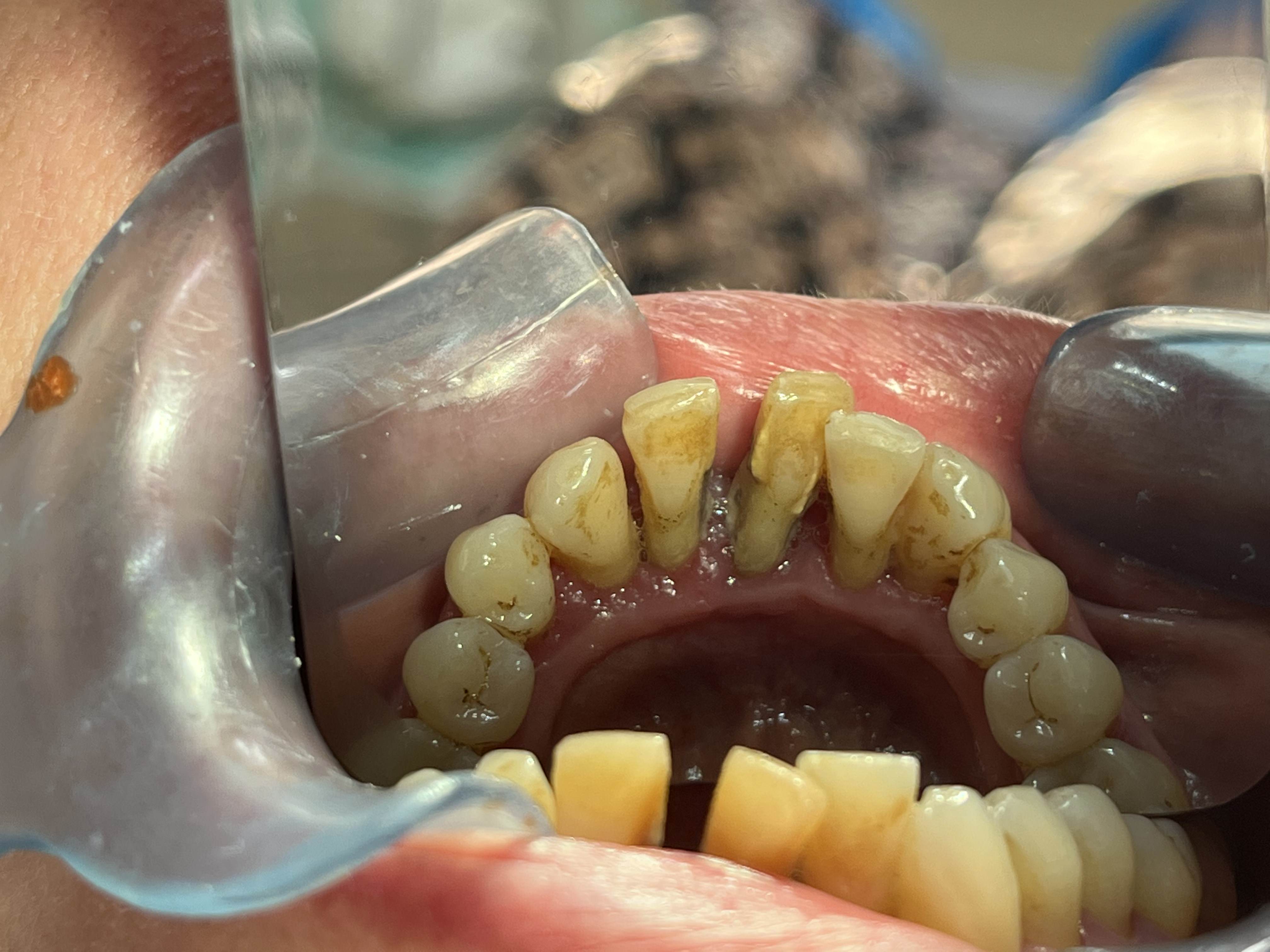 Immediate Implants #42 #32  with Fixed Restoration