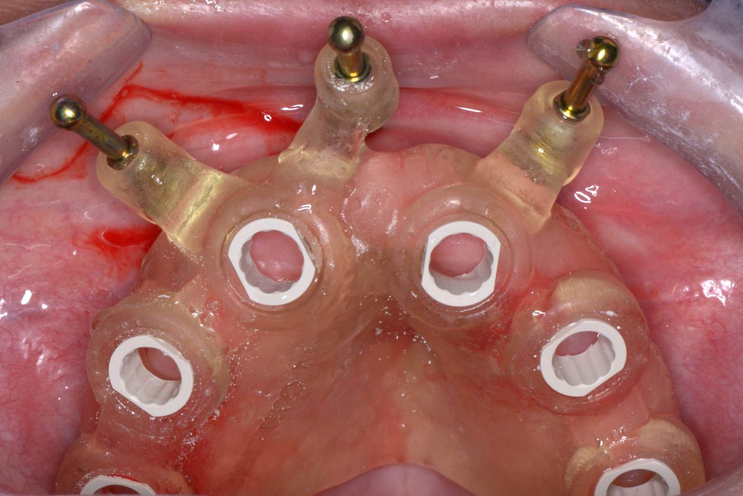 Tissue-supported guide